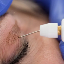 Upload image to gallery viewer, Blepharoplasty without Cuts with Plasma Jet Eyelid Lift