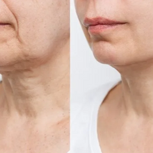 Upload image to gallery viewer, Nefertiti Botulinum Toxin Botox in the Neck