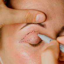 Upload image to gallery viewer, Blepharoplasty without Cuts with Plasma Jet Eyelid Lift