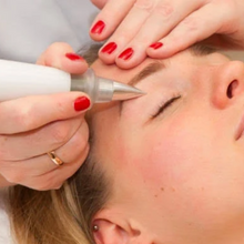 Upload image to gallery viewer, Blepharoplasty without Cuts with Plasma Jet Eyelid Lift