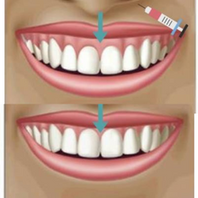 Carregar imagem no visualizador da galeria, Sorriso Gengival Toxina Botulínica Botox