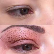 Upload image to gallery viewer, Blepharoplasty without Cuts with Plasma Jet Eyelid Lift