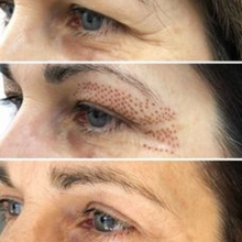 Upload image to gallery viewer, Blepharoplasty without Cuts with Plasma Jet Eyelid Lift