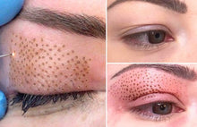 Carregar imagem no visualizador da galeria, Jato de Plasma Facial para Tratar Linhas Rugas e Cicatrizes de Acne