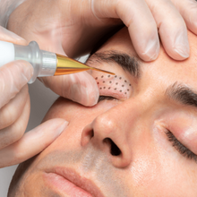 Upload image to gallery viewer, Blepharoplasty without Cuts with Plasma Jet Eyelid Lift