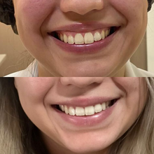 Carregar imagem no visualizador da galeria, Sorriso Gengival Toxina Botulínica Botox