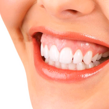 Carregar imagem no visualizador da galeria, Sorriso Gengival Toxina Botulínica Botox