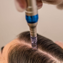 Carregar imagem no visualizador da galeria, Microagulhamento Capilar para Queda de cabelos Tratamento