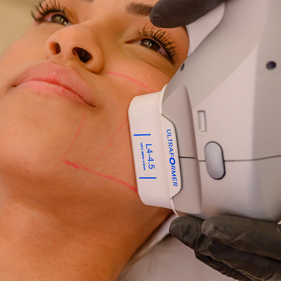 Ultraformer MPT para Full face e papada - Ultrassom microfocado