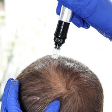 Carregar imagem no visualizador da galeria, Microagulhamento Capilar para Queda de cabelos Tratamento