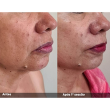 Carregar imagem no visualizador da galeria, Hipro Ultrassom Microfocado Hi pro Full Face Lifting Facial
