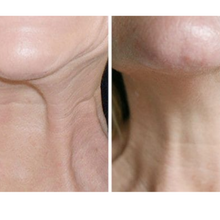 Upload image to gallery viewer, Nefertiti Botulinum Toxin Botox in the Neck
