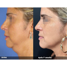 Carregar imagem no visualizador da galeria, Hipro Ultrassom Microfocado Hi pro Full Face Lifting Facial
