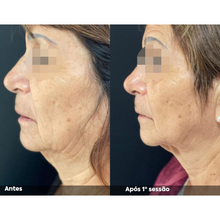 Carregar imagem no visualizador da galeria, Hipro Ultrassom Microfocado Hi pro Full Face Lifting Facial
