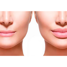 Upload image to gallery viewer, Lip Filling with Hyaluronic Acid
