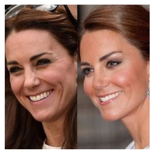 Carregar imagem no visualizador da galeria, Botox Toxina Botulínica para Testa Olhos e Glabela Allergan

