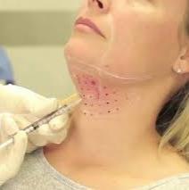 Carregar imagem no visualizador da galeria, Lipo de Papada Enzimática Intradermoterapia Emagrecimento
